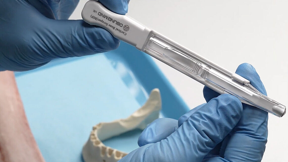 Bone Scraper Tutorial – Einfachen Entnahme autologer kortikaler Knochenspäne
