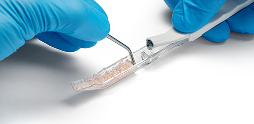 Bone Scraper Anwendung: Die transparente Kammer des Knochenschabers laesst sich mit Fingerdruck nach vorne oeffnen, und die Knochenspaene lassen sich mit einem Instrument entnehmen.