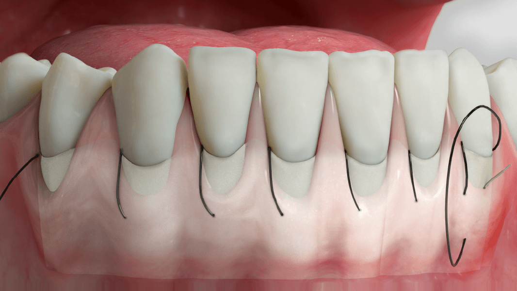 Recouvrement de récessions – la technique de tunnelisation